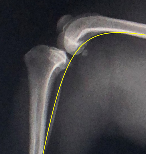 左前十字靭帯断裂・ 左膝蓋骨内方脱臼